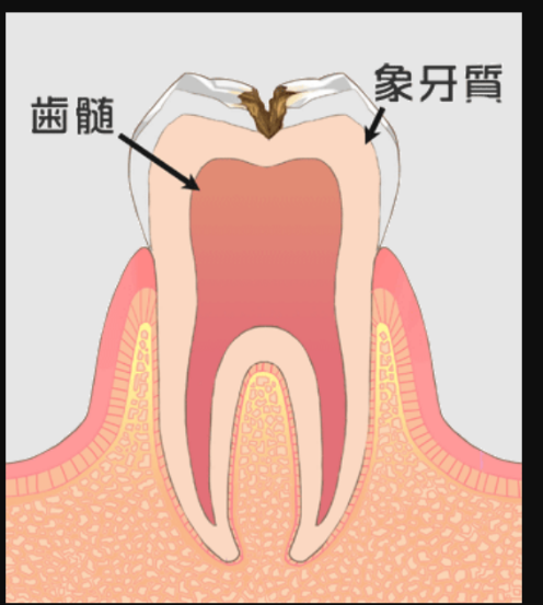 神経まで行く途中（エナメル質から象牙質）の虫歯（C2）
