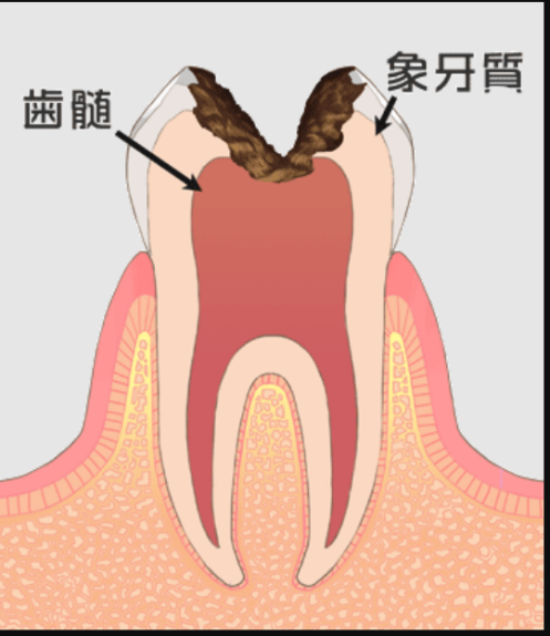 神経（歯髄）まで進行した（エナメル質から歯髄）の虫歯（C3）