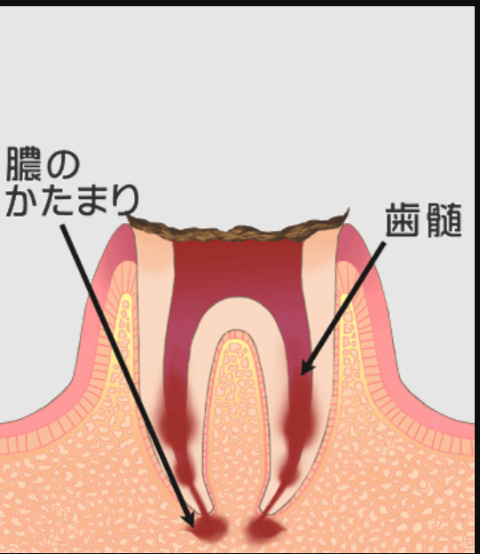 むし歯で歯が崩壊して根っこのみの状態（エナメル質から歯髄まで崩壊）（C4）