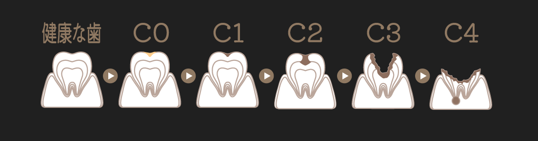 むし歯の進行度による分類