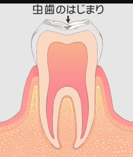 初期う蝕（むし歯）（C0）