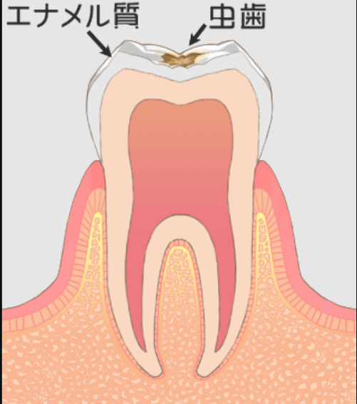 歯の表面の溝が茶色くなったり、少し表面だけが凹んでいる（C１）